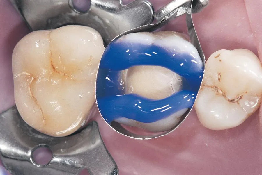 D-Tech Dental Etch Etching Gel