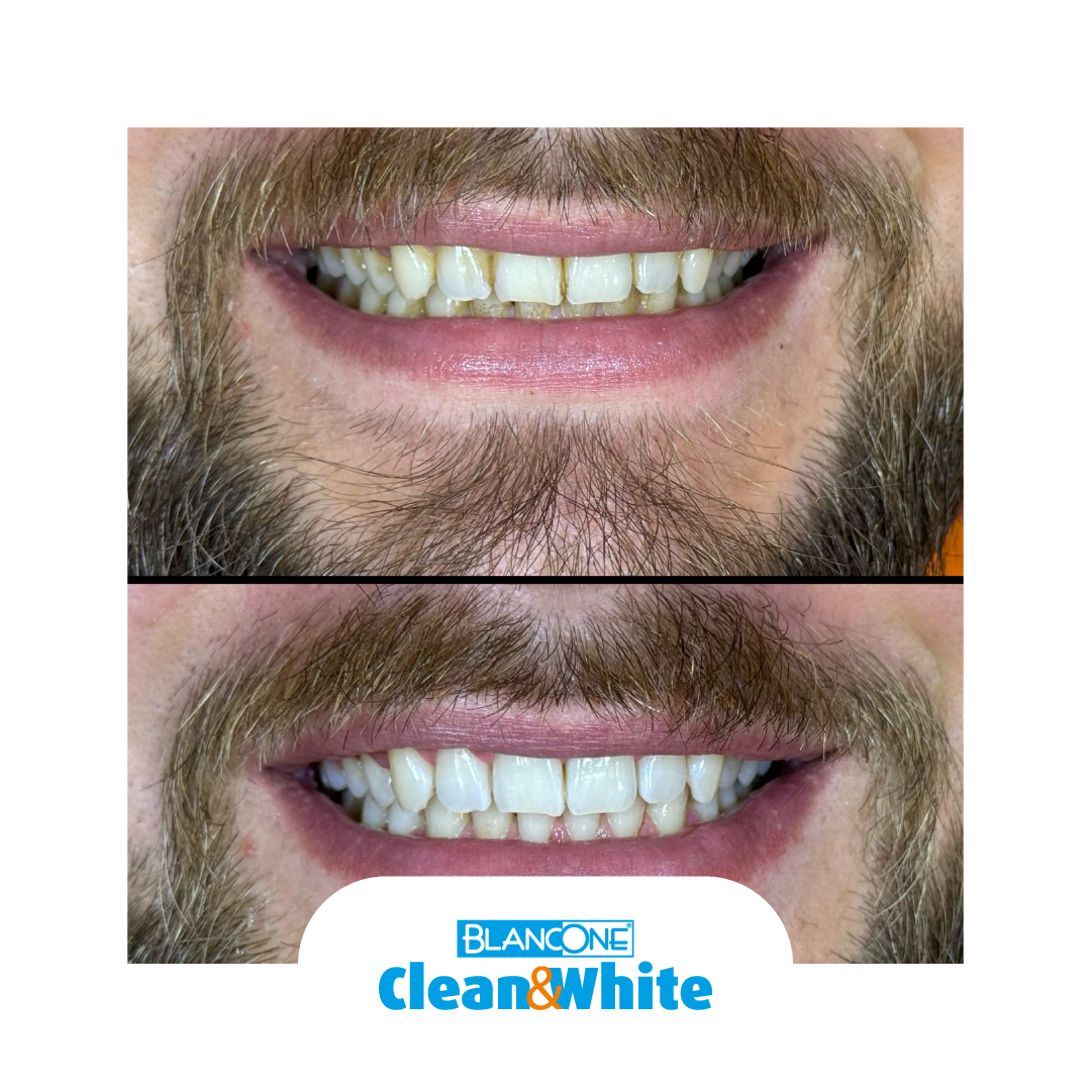 BLANCONE TEETH WHITENING SYSTEM