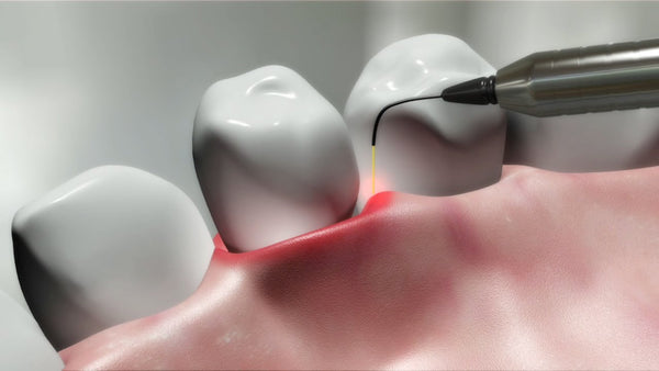 Laser Dentistry – An Innovative Tool in Modern Dentistry