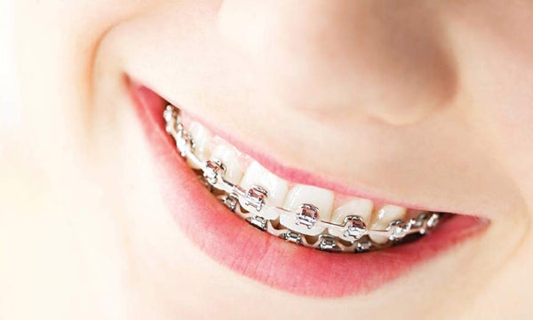 An Ultimate Guide on Orthodontic Wires