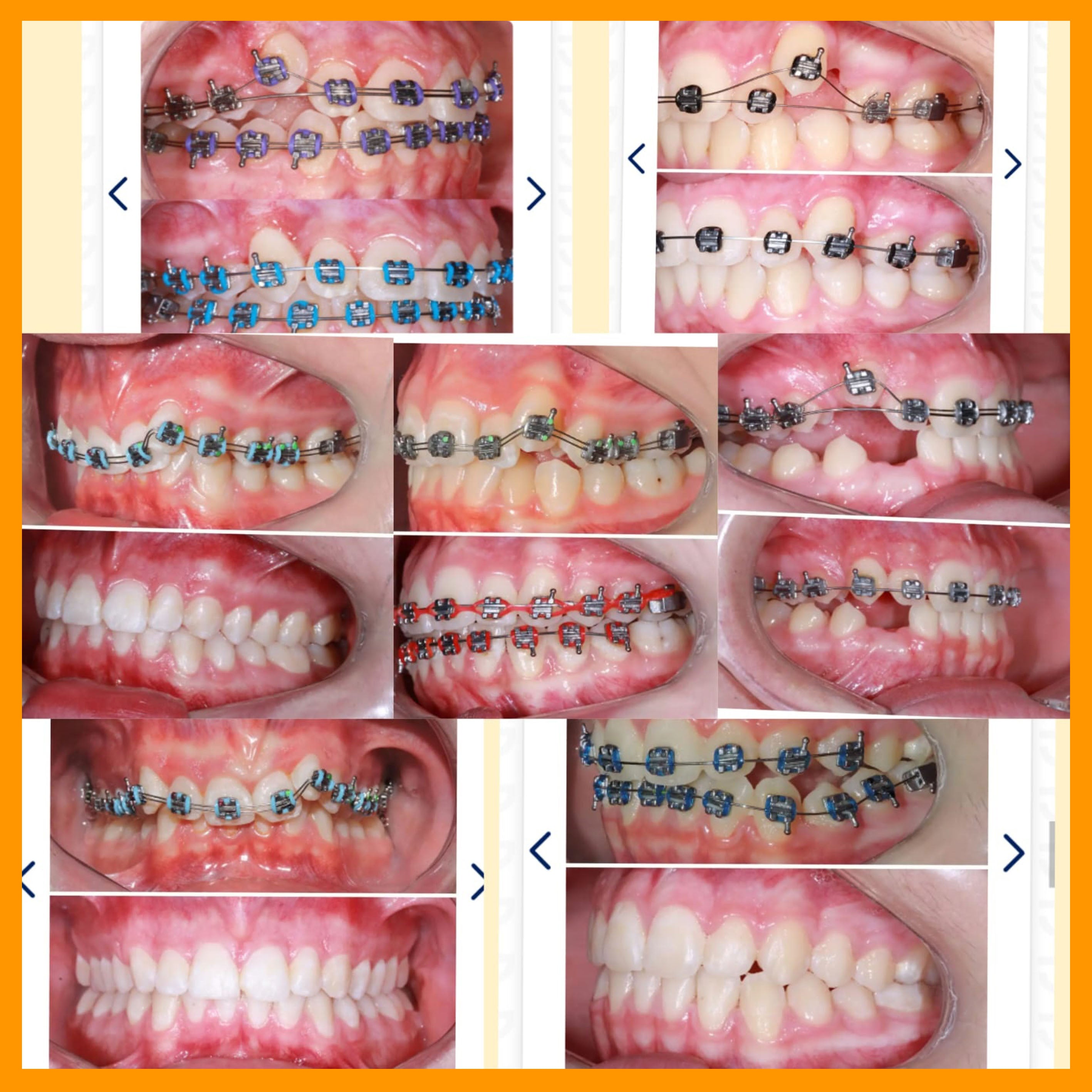 KODEN Duploslot Bracket 7x7