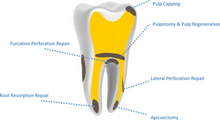 Kids-e-Dental E-MTA (Mineral Trioxide Aggregate)