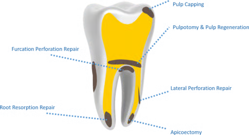Kids-e-Dental E-MTA (Mineral Trioxide Aggregate)