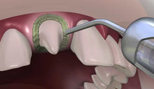Prevest DenPro Hemostal Gel